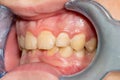 Close-up of macro dental calculus and dental plaque. Oral hygiene in dentistry