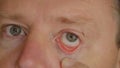 Close-up male eye with reddened eyelid and cornea, conjunctivitis