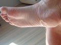 Close-up of a male foot with peeling skin. Avitaminosis. Disease. Dry problematic skin on the feet. Health care concept