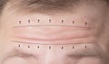 Close-up of male forehead with wrinkles and markers for surgery. Forehead plastic surgery concept, forehead wrinkle lift, Royalty Free Stock Photo