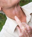 Close up of male hand and neck with vitiligo pigments Royalty Free Stock Photo