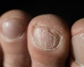 Close-up of male toes with a cracked nail