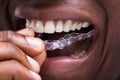 Man Adjusting Transparent Aligners In His Teeth Royalty Free Stock Photo