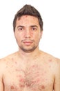 Close up man with chickenpox Royalty Free Stock Photo