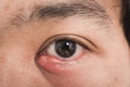 Close up of man eye stye