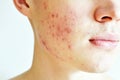 Close up of man with problematic skin and scars from acne. Royalty Free Stock Photo