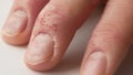 Close-up of a man`s fingers suffering from psoriasis. Eczema on the hands