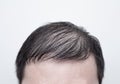 Close up man`s head with hair loss, thinning hair or alopecia isolated on white background. Hair problem