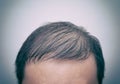 Close up man`s head with hair loss, thinning hair or alopecia isolated on white background with old analog film effect. Hair