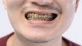 Close up of Man`s mouth with braces , yellow plaque teeth because drinking coffee regularly