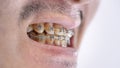 Close up of Man`s mouth with braces , yellow plaque teeth because drinking coffee regularly