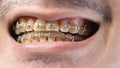 Close up of Man`s mouth with braces , yellow plaque teeth because drinking coffee regularly