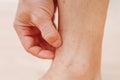 Close up man scratching with hand allergic rash on leg. Leg with red rash caused by insect bites. Dermatitis Royalty Free Stock Photo