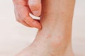 Close up man scratching with hand allergic rash on leg. Leg with red rash caused by insect bites. Dermatitis Royalty Free Stock Photo
