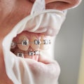 Teeth with metal braces and cofferdam in mouth. Royalty Free Stock Photo