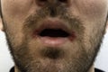 Close-up on a man with two oral herpes (herpes simplex) on his mouth.