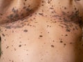 Close-up many large big brown nevus on human chest skin body Royalty Free Stock Photo