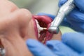 Close-up medical dentist procedure of teeth polish