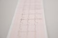 Close up. Medical research. ECG Tape with mild arrhythmia. Royalty Free Stock Photo