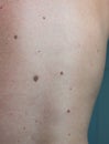 Close up the melanoma black spot on human skin.