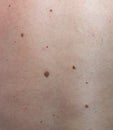 Close up the melanoma black spot on human skin.