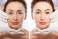 Close up middle age woman macro face before after collagen injection. Face lifting, anti aging concept. Plastic surgery, cosmetic Royalty Free Stock Photo