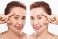 Close up middle age woman macro face before after collagen injection. Face lifting, anti aging concept. Plastic surgery, cosmetic Royalty Free Stock Photo