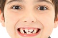 Close Up Missing Teeth Royalty Free Stock Photo