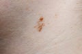 Close-up of a Mole on Human Skin Royalty Free Stock Photo