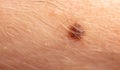 Close-up of a mole on human skin Royalty Free Stock Photo