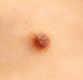 Close-up of a mole on human skin Royalty Free Stock Photo
