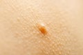 Close up of Molluscum Contagiosum also called water wart