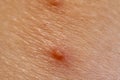 Close up of Molluscum Contagiosum also called water wart