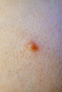 Close up of Molluscum Contagiosum also called water wart