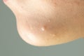 Close-up of Molluscum Contagiosum also called water wart. Viral formations in the chin on the skin of the child