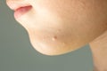 Close-up of Molluscum Contagiosum also called water wart. Viral formations in the chin on the skin of the child Royalty Free Stock Photo