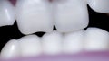 Close-up of a mouth with crooked teeth and malocclusion