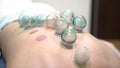 Close up for multiple vacuum cups, medical cupping therapy on human body, wellness, body health concept. Doctor removes