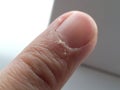 Close up of my index fingers with dry, cracked skin on cuticles, skin is torn and flaking off. Royalty Free Stock Photo