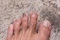 Close up of Nail infections