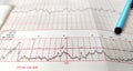 Close up NST paper, medical method for monitoring Fetal heart rate and uterine contractions in pregnancy in hospital.