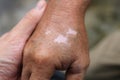 Close-up of old man's hands with vitiligo skin discoloration. a way of life with seasonal skin conditions. Royalty Free Stock Photo