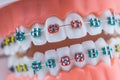 Close-up of a orthodontic model jaws and teeth with braces Royalty Free Stock Photo