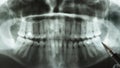 Close-up of panoramic dental x-ray. Pen points to abnormal location of wisdom teeth on lower jaw area
