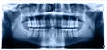 Close up. Panoramic image of the jaw, primary adentia of the third molar. Medical examination of teeth, maxillofacial surgery