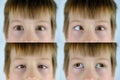 Close-up of part of child`s face, brown eyes of boy 8-10 years old brown eyes look up, little patient with strabismus, concept of