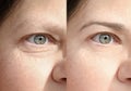 close up part face mature woman 55 years old, human eye, lower, upper eyelid, deep facial wrinkles around eyes before and after