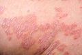 Close up part of human skin affected by psoriasis