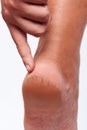 Close-up of a person's cracked heels Royalty Free Stock Photo