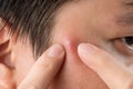 Close up photo of acne prone skin, a man squeezing his pimple